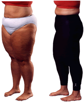 cellulite e buccia di arancia cellulite e buccia di arancia